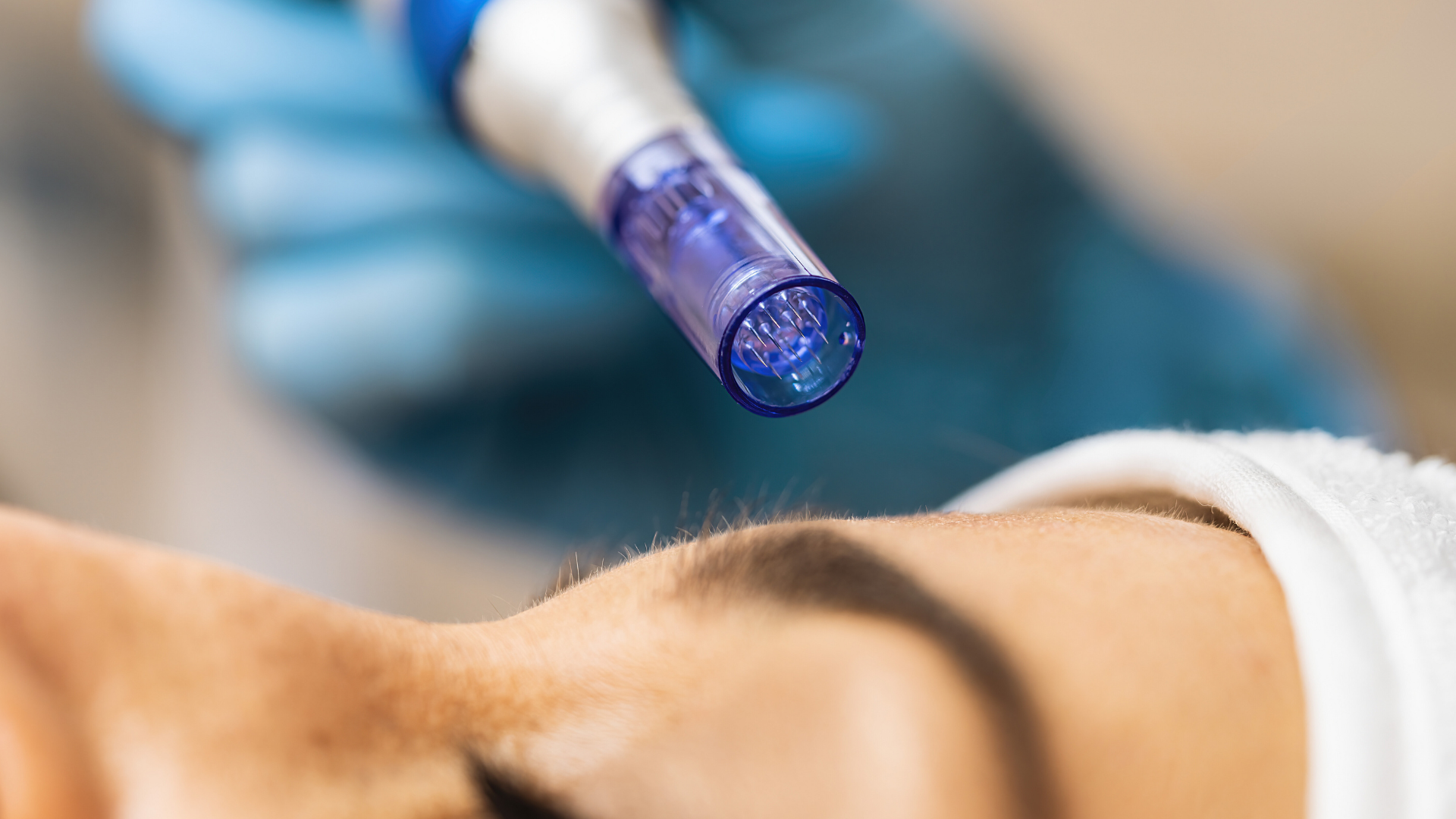 All About Microneedling The Good, the Bad, and the FAQs