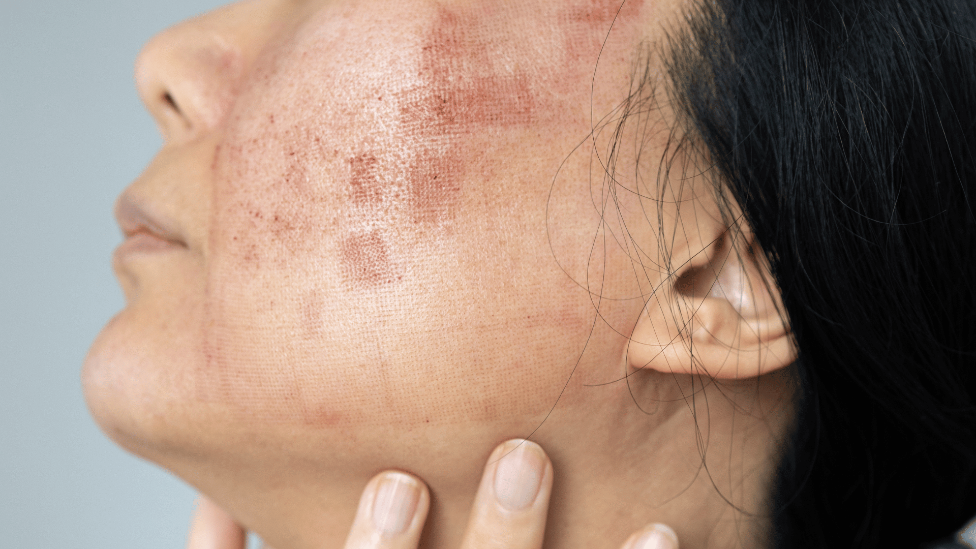 Post-treatment skincare; Dr. Karam's advice for your routine during recovery