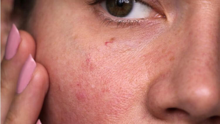 Close-up of a woman’s cheek showing redness, blemishes, and visible skin texture.