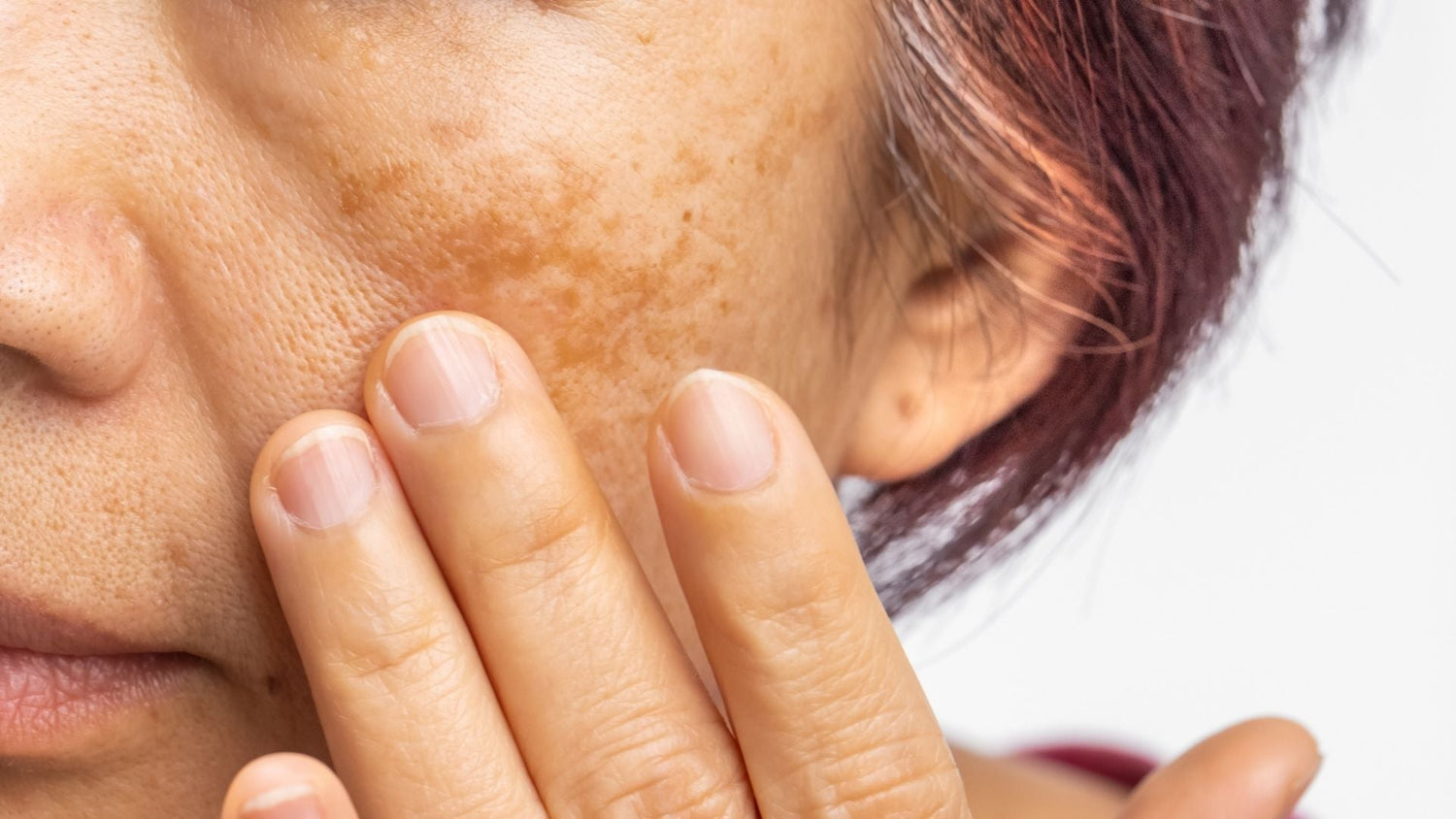 A woman with the melasma skin condition