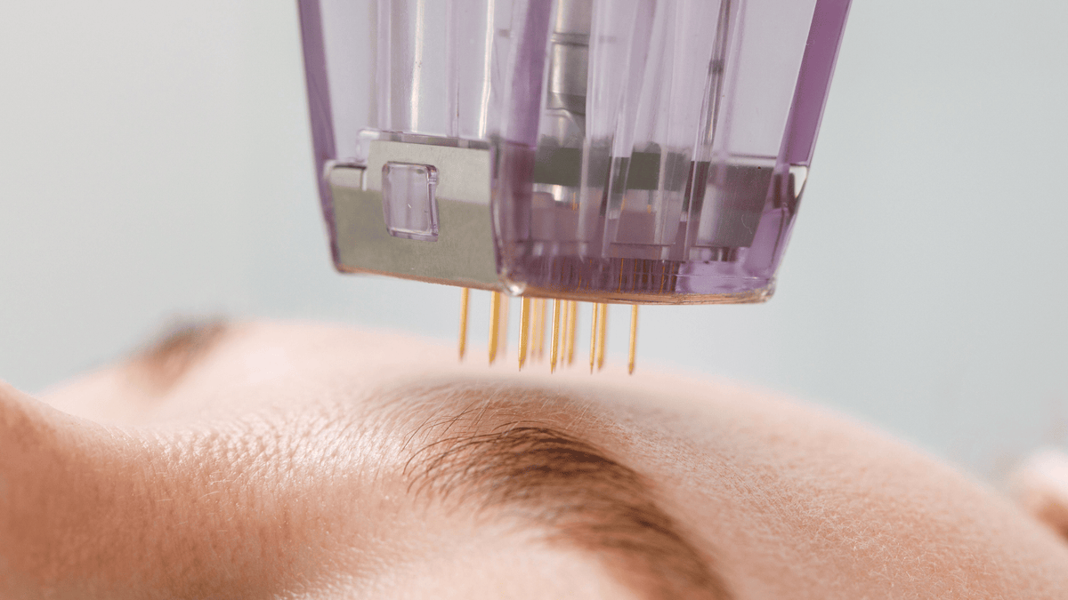 Woman getting RF microneedling done to her skin
