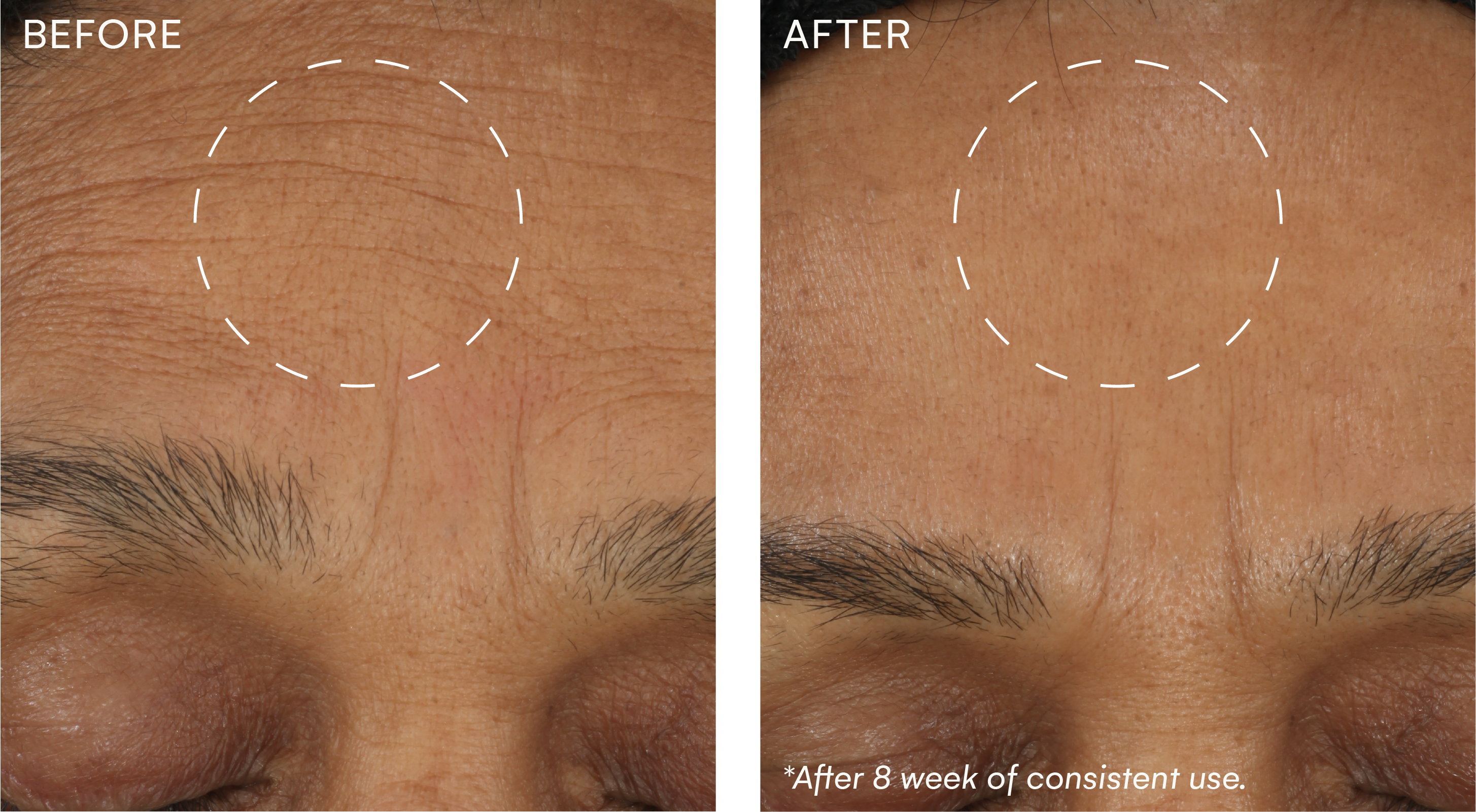 A comparison of a forehead before and after 8 weeks of consistent use. The after image has notably reduced forehead lines.