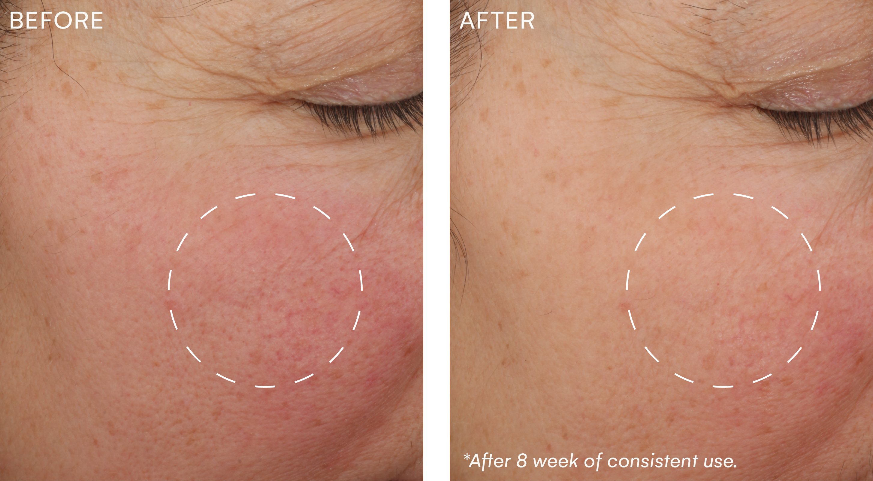 Split-screen “Before” and “After” close-up of the same cheek, highlighting a circled area with visibly reduced redness and more even skin tone after 8 weeks of consistent use.