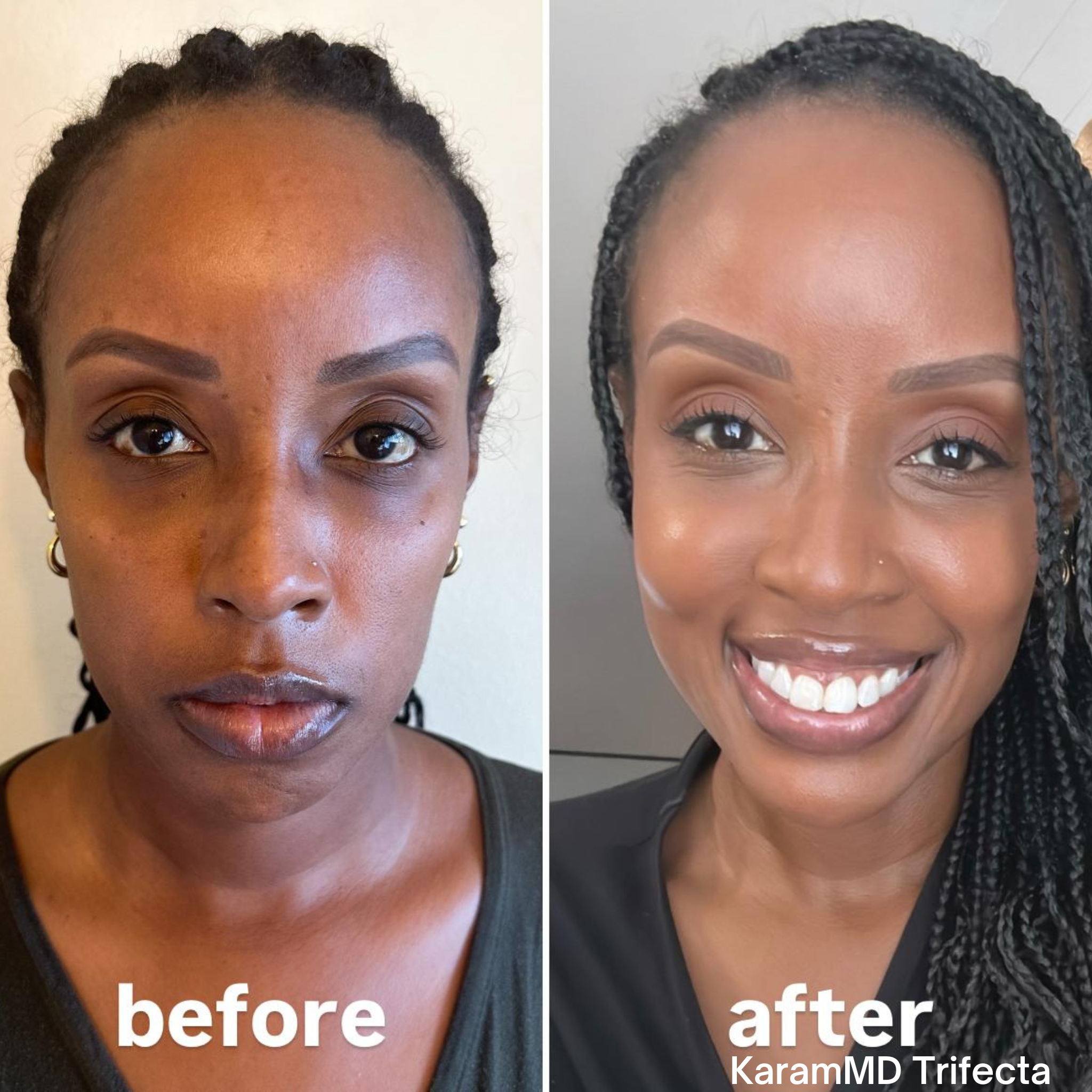 Before and after comparison of a woman's face with KaramMD Trifecta product, showing smoother, brighter skin.