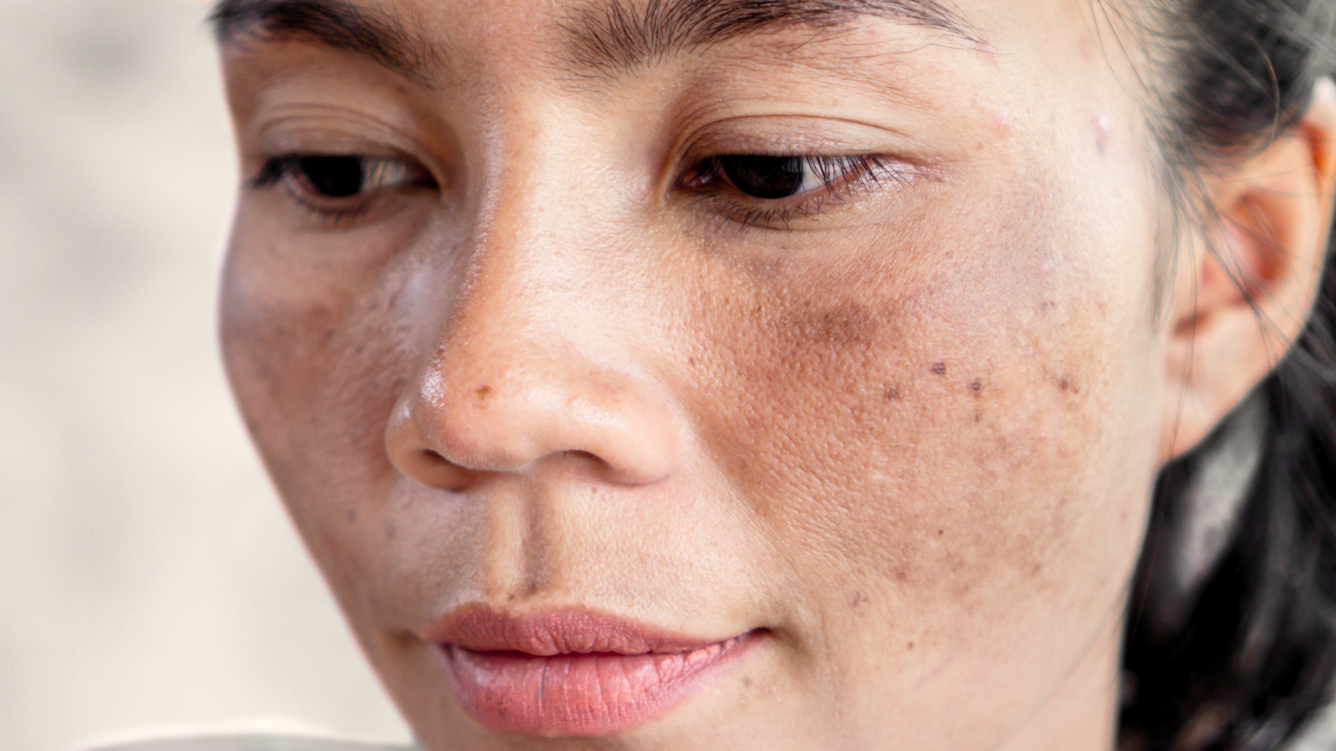 woman with dark spots of hyperpigmentation and melasma