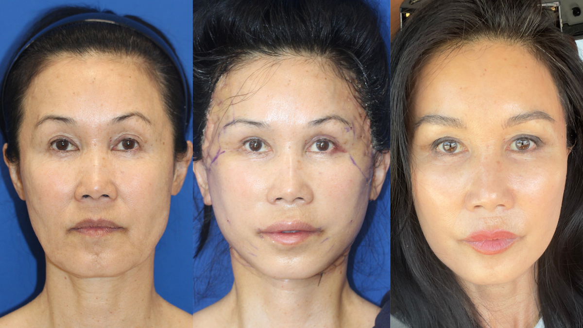She Already Looked Great at 60. So Why Did She Choose a Facelift?