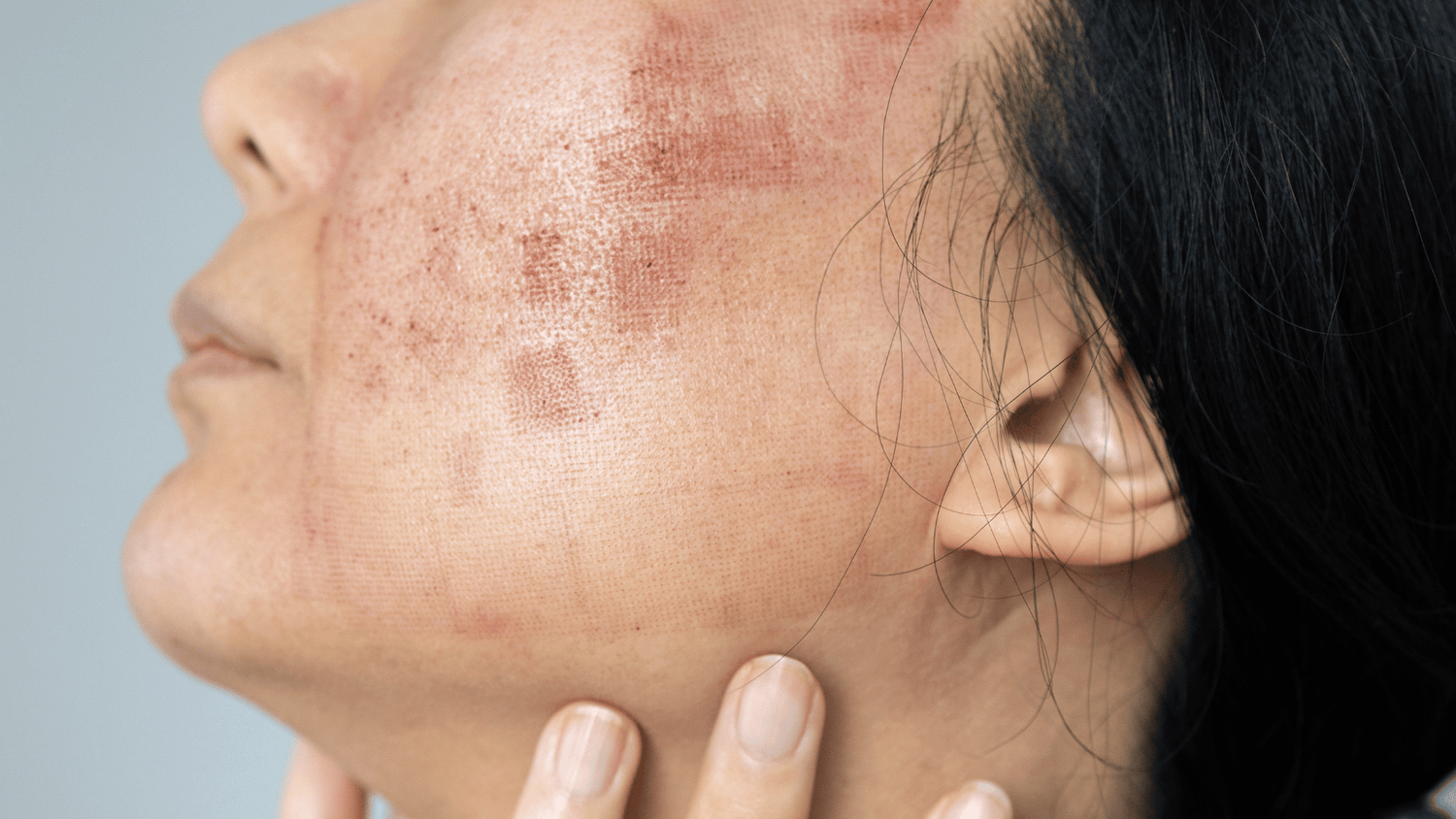 Post-treatment skincare; Dr. Karam's advice for your routine during recovery