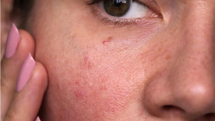 woman with sensitive skin on face