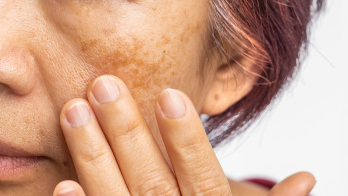 Understanding Melasma: How To Prevent & Treat this Skin Condition