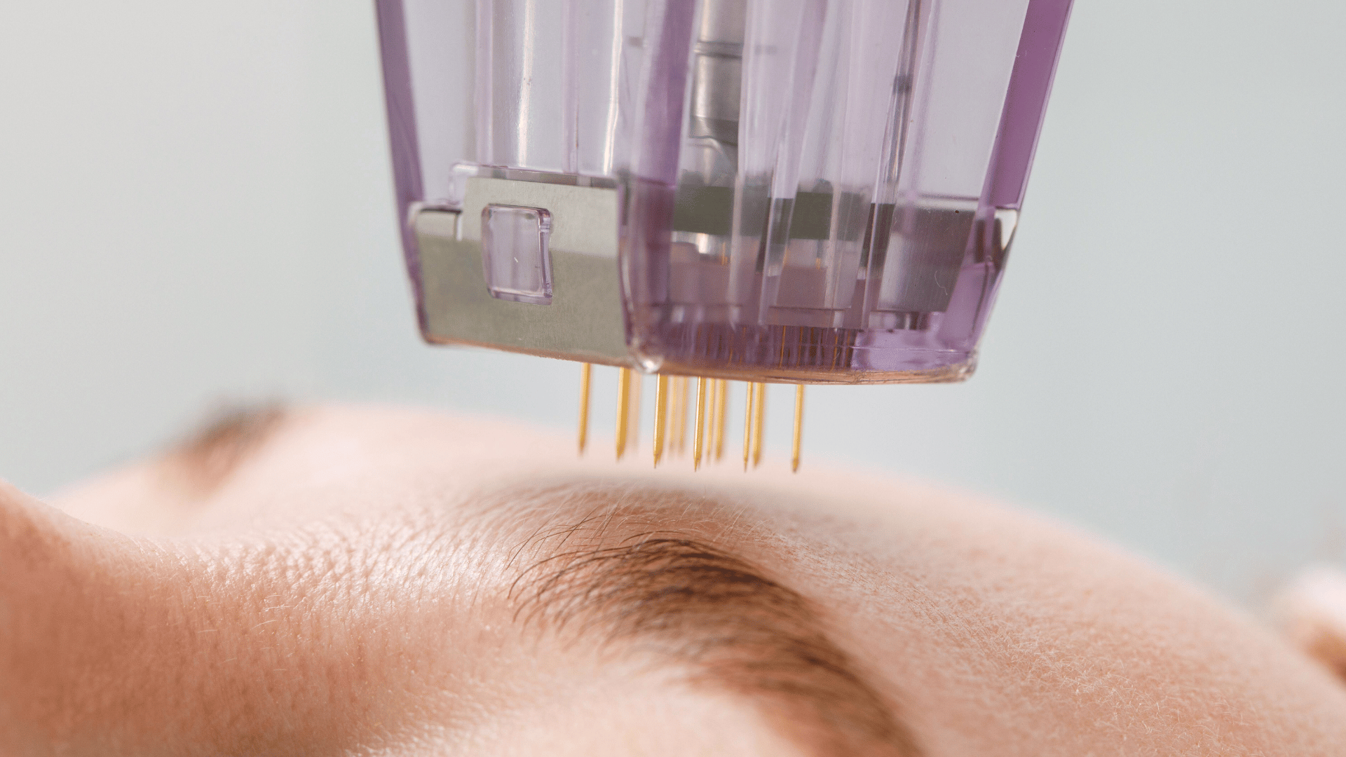 Woman getting RF microneedling done to her skin