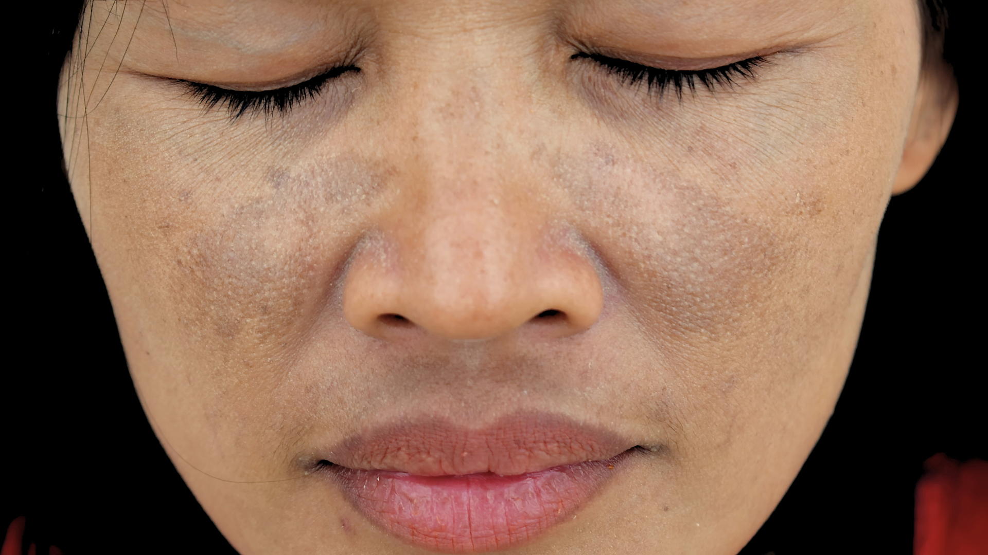 Perpigmentation Hyperpigmentation vs. Melasma + Best Ingredients for Dark Spots