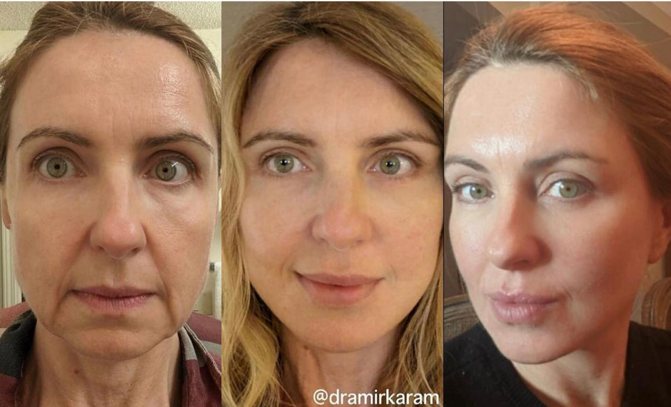 Dr. Karam's patient using Trifecta skincare after Vertical Restore procedure