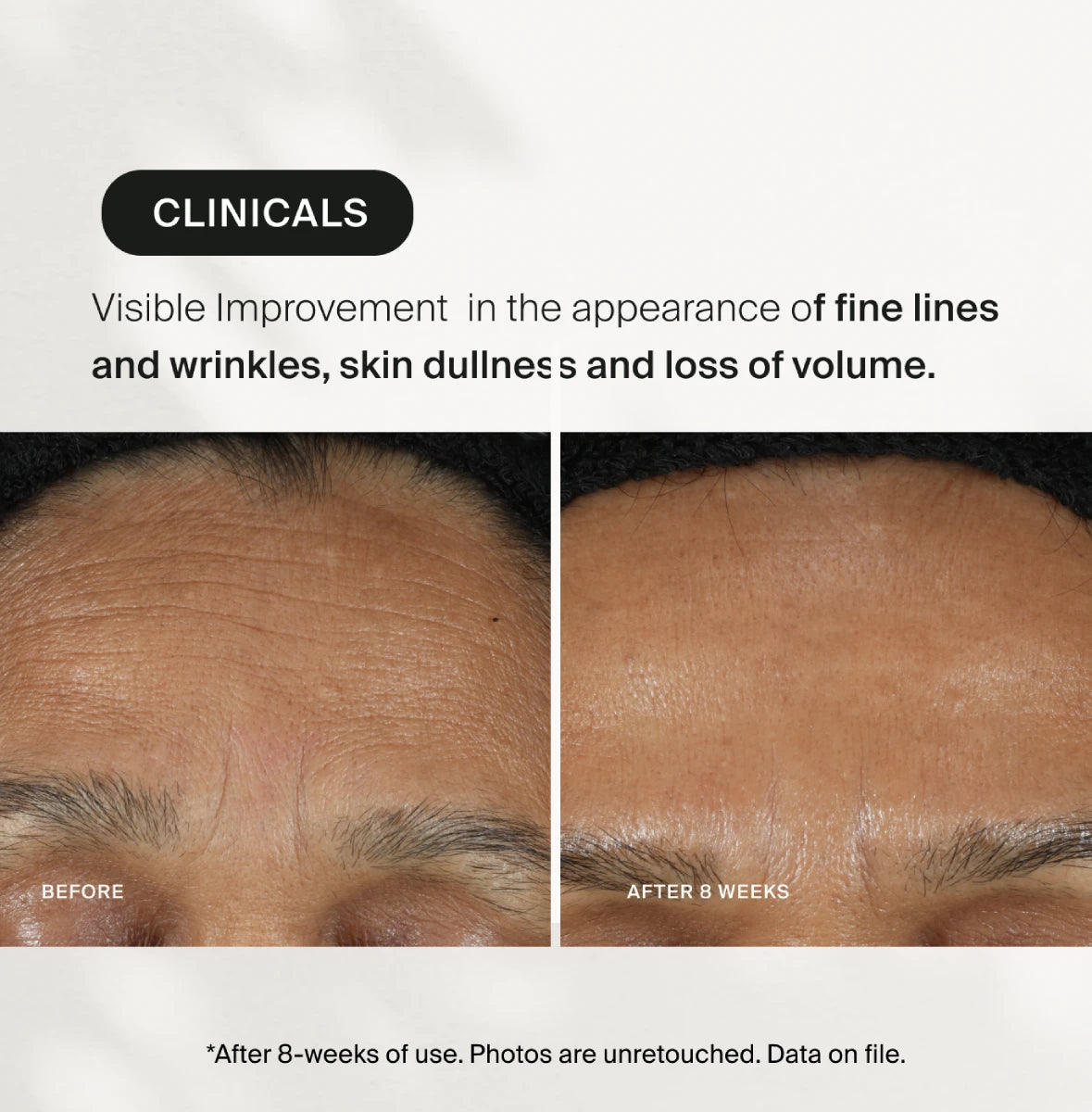 Before and after comparison of skin texture with text indicating clinical improvement.